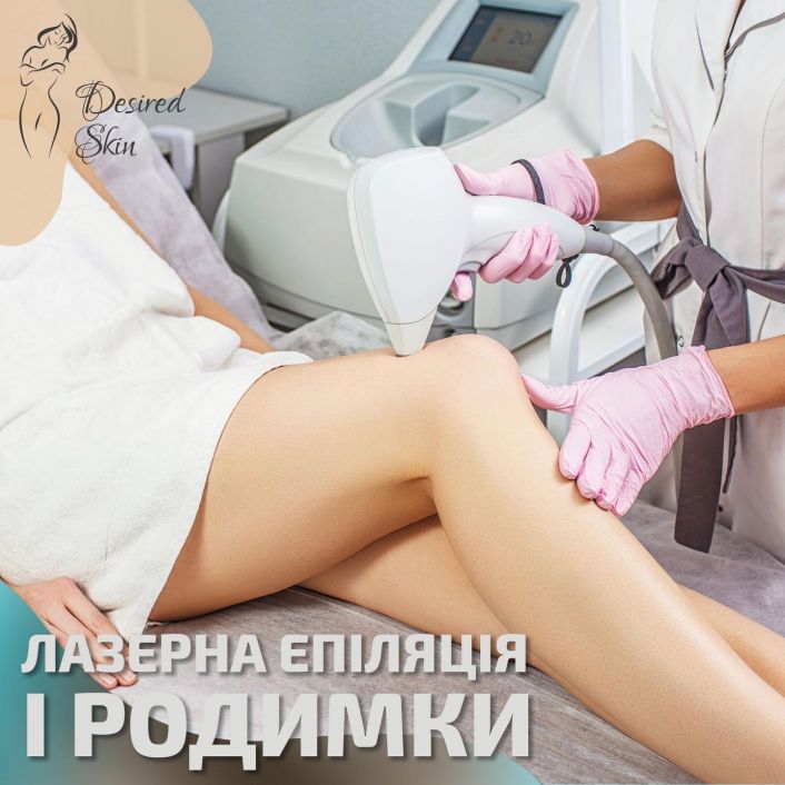 Лазерна епіляція і родимки image
