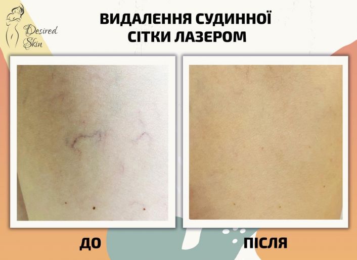 Видалення судинної сітки лазером image