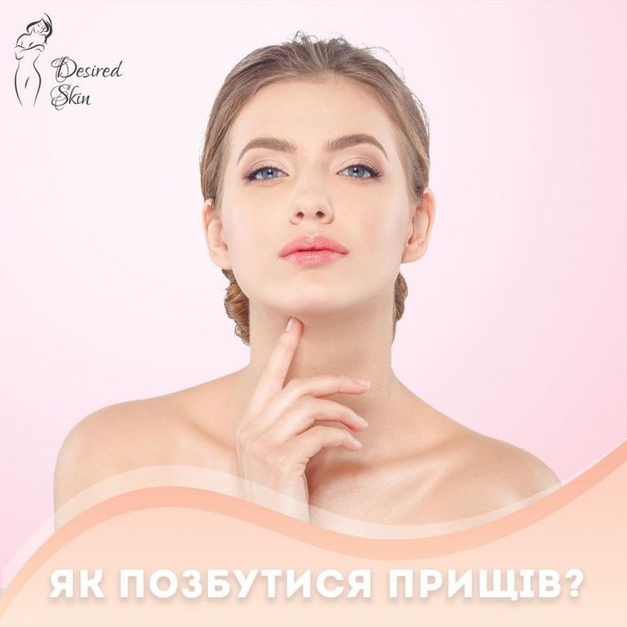 Як позбутися прищів image