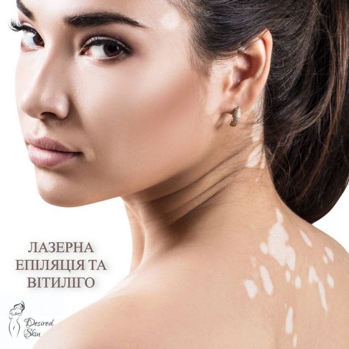 Лазерна епіляція та вітиліго image